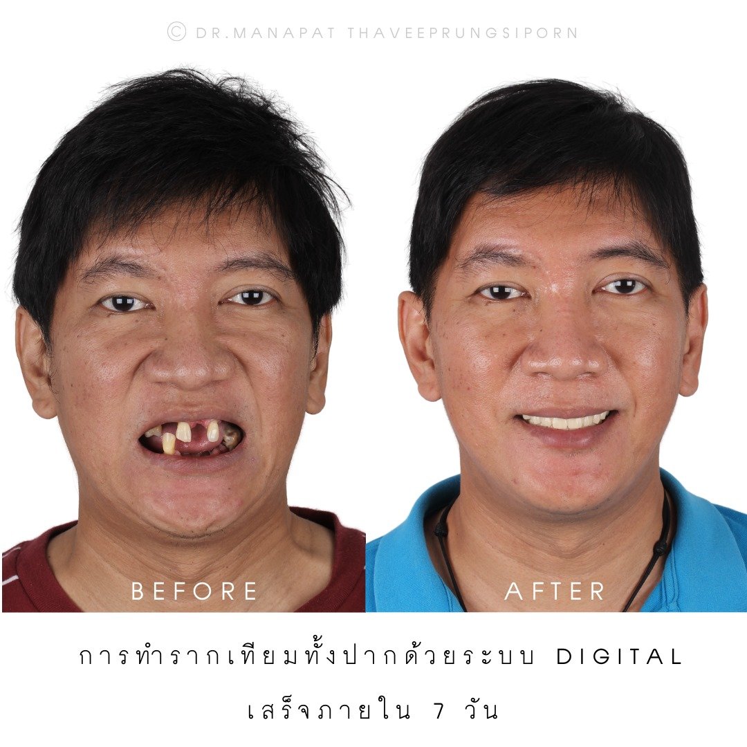 Full Mouth Implant Rehabilitation With Full Digital Workflow in 7 Days 