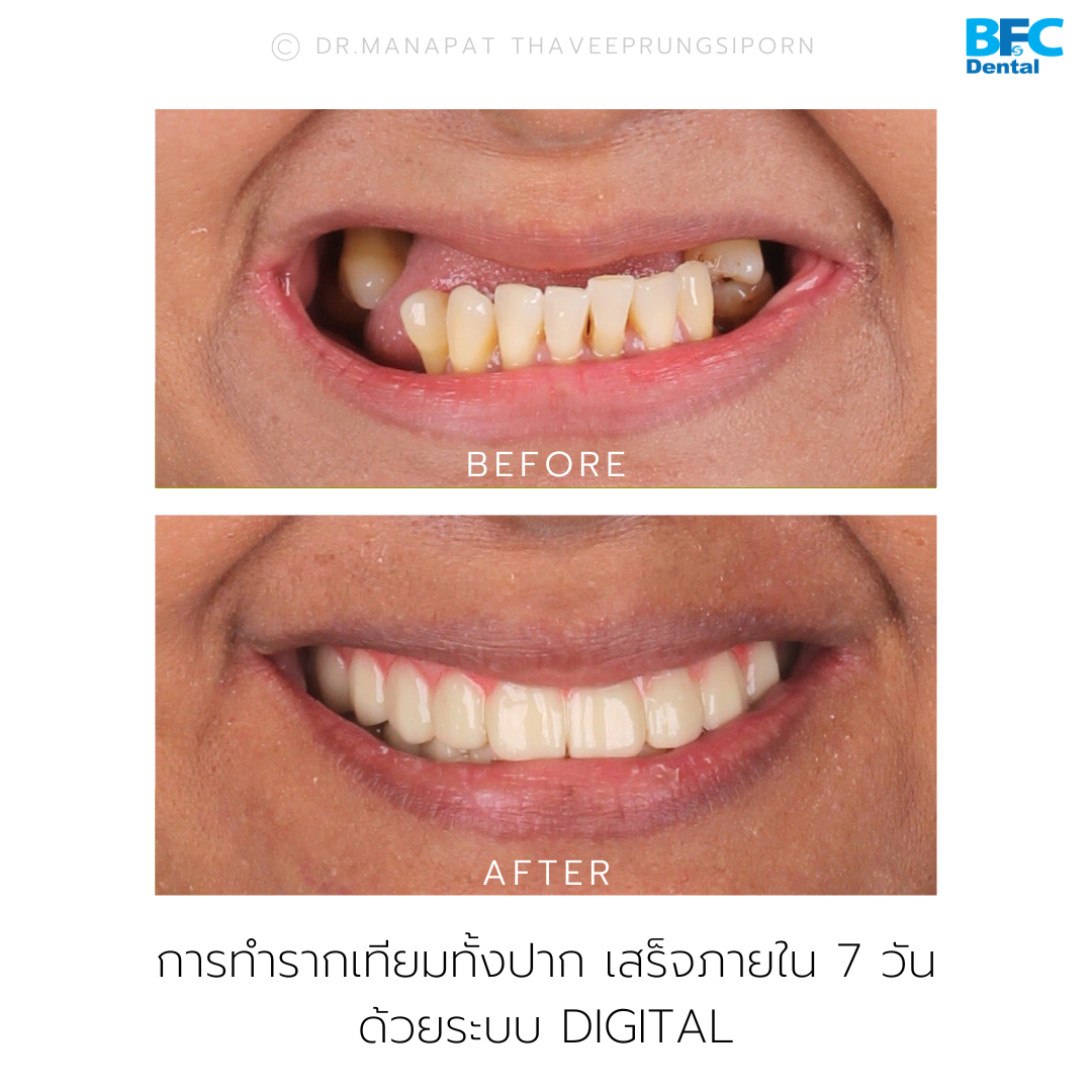 Smile Transformation in 7 Days 