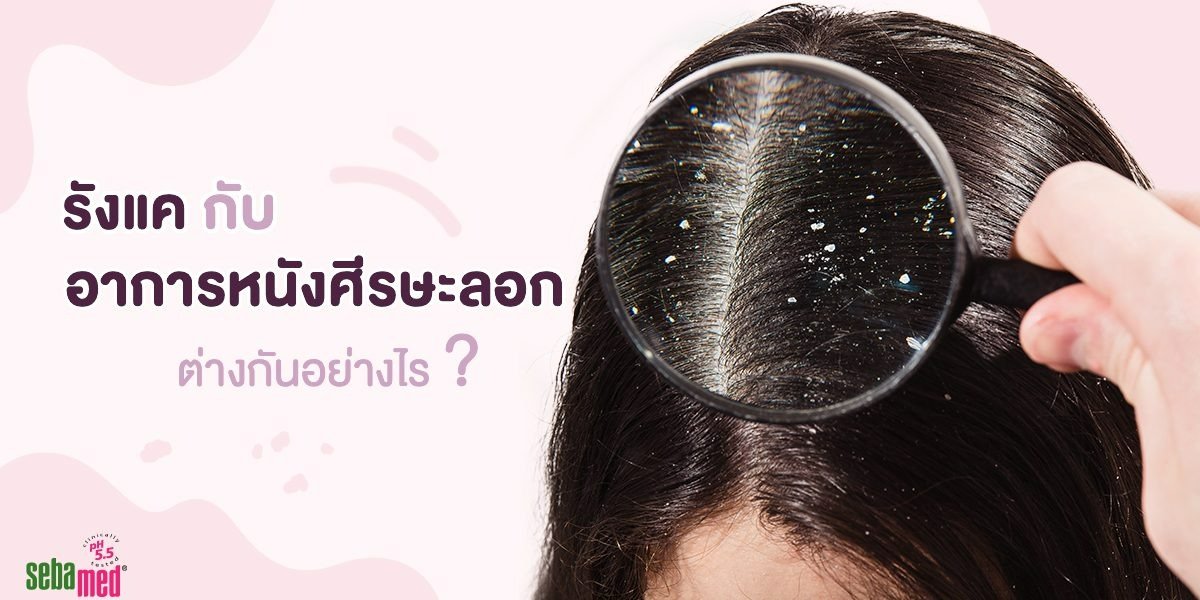  รังแคกับอาการหนังศรีษะลอกต่างกันอย่างไร?