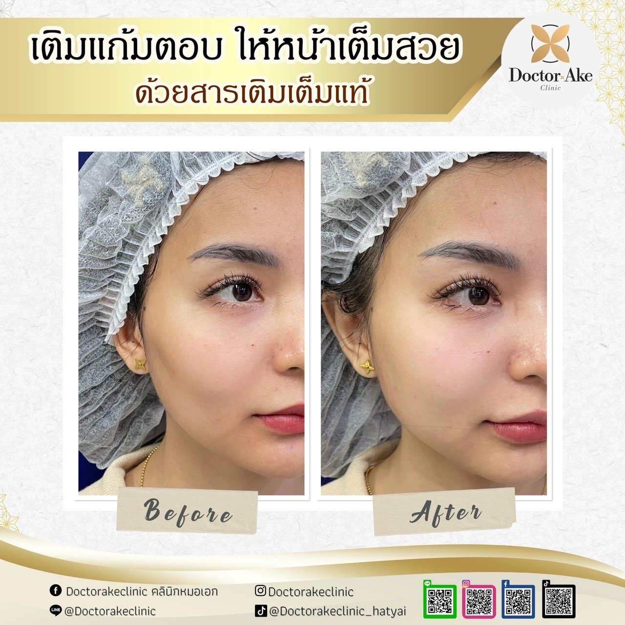Filler แก้มส้ม แก้มตอบ