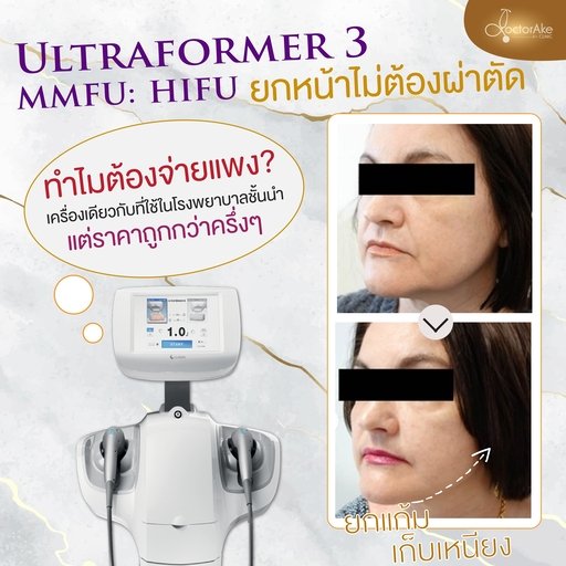 Ultraformer III