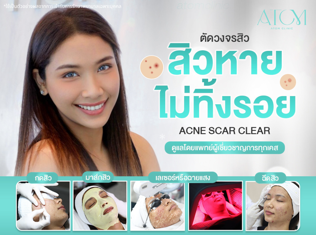 รักษาสิว สิวอักเสบ สิวอุดตัน อะตอมคลินิก