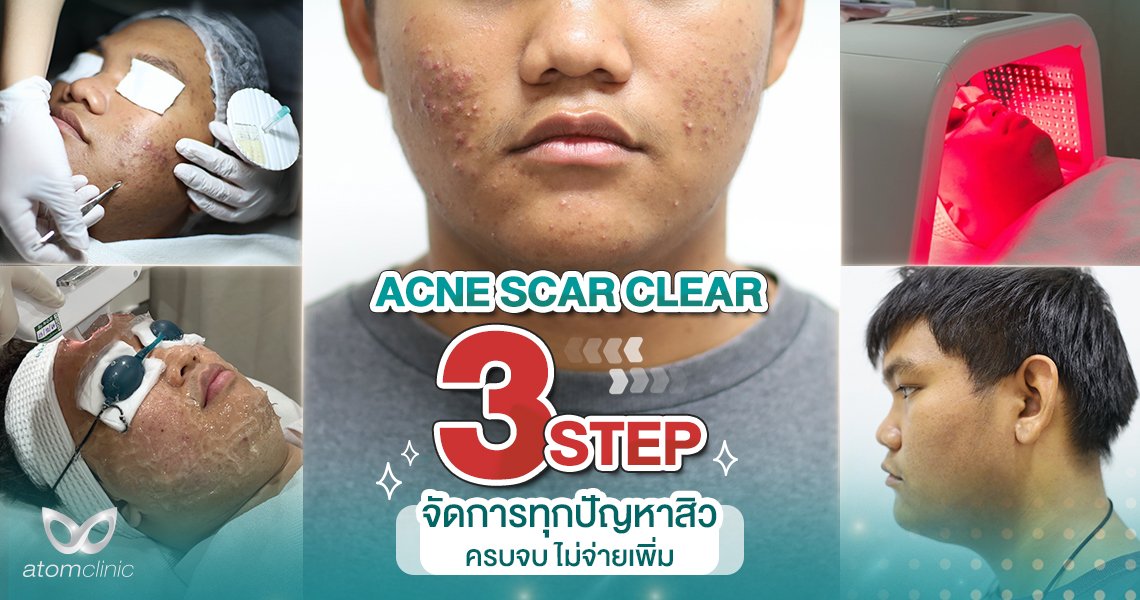 รีวิว รักษาสิวและรอยสิว ครบจบไม่ต้องจ่ายเพิ่ม ACNE SCAR CLEAR รีวิว รักษาสิวและรอยสิว ครบจบไม่ต้องจ่ายเพิ่ม ACNE SCAR CLEAR