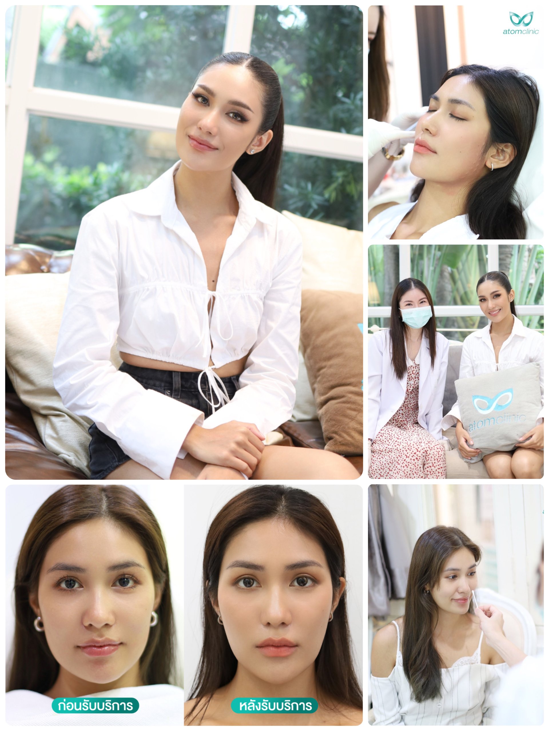 Botox ลดกราม หน้าเรียว
