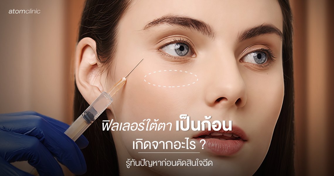 ฟิลเลอร์ใต้ตาเป็นก้อน เกิดจากอะไร? รู้ทันปัญหาก่อนตัดสินใจฉีด