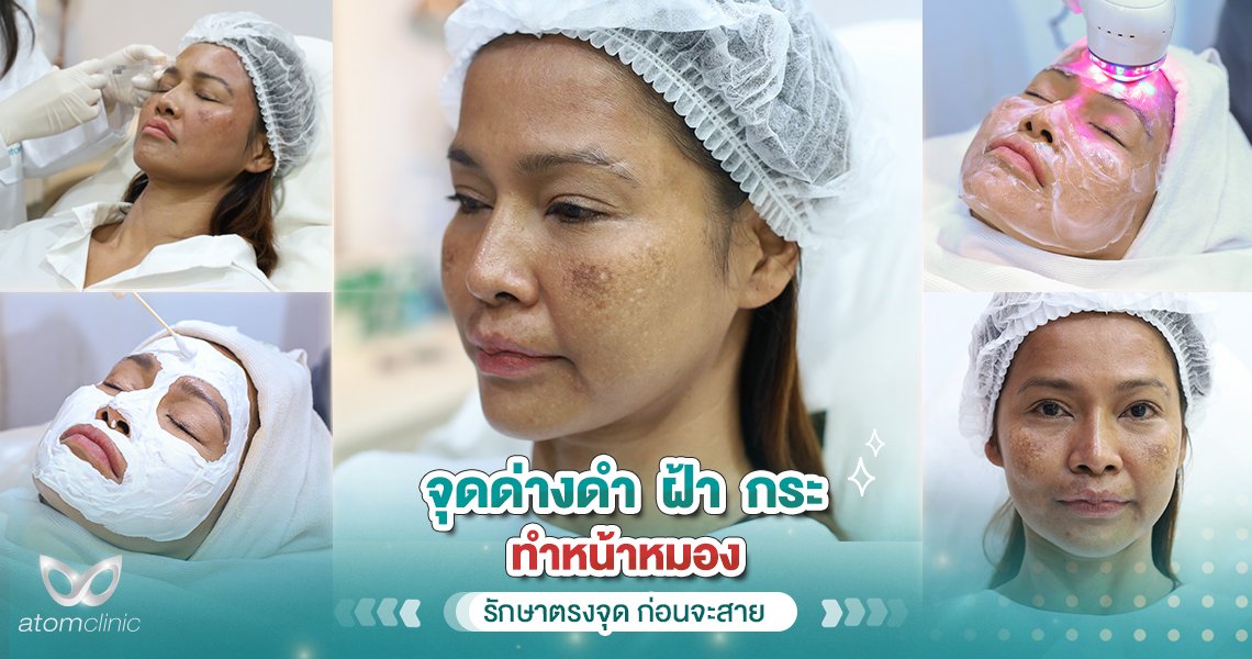 จุดด่างดำ ฝ้า กระ จุดด่างดำ ฝ้า กระ