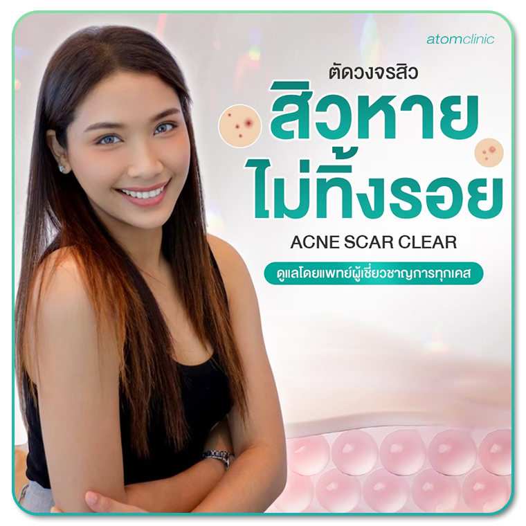 รักษาสิว อะตอมคลินิก