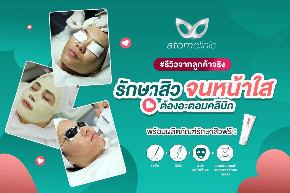 รีวิวจากลูกค้าจริง รักษาสิว กับอะตอมคลินิก หน้าใส สิวหายเกลี้ยง ด้วยโปรแกรม Acne Scar Clear รีวิวจากลูกค้าจริง รักษาสิว กับอะตอมคลินิก หน้าใส สิวหายเกลี้ยง ด้วยโปรแกรม Acne Scar Clear