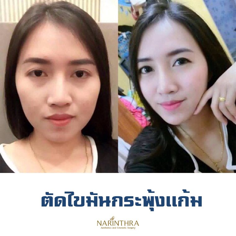 การผ่าตัดไขมันกระพุ้งแก้ม  การผ่าตัดไขมันกระพุ้งแก้ม