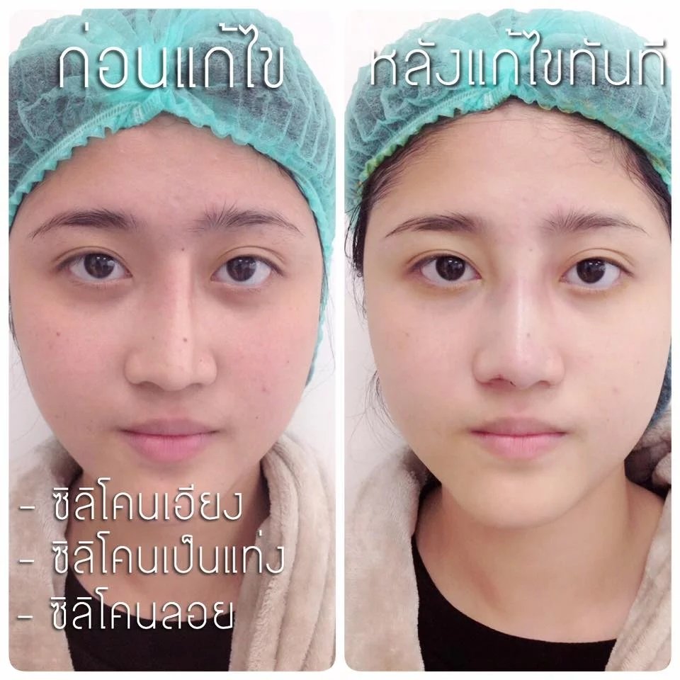 บทความ: ซิลิโคนลอยเป็นอันตรายจริงหรือหลอก ดูยังไงว่าลอยหรือเคลื่อน ?  บทความ: ซิลิโคนลอยเป็นอันตรายจริงหรือหลอก ดูยังไงว่าลอยหรือเคลื่อน ?