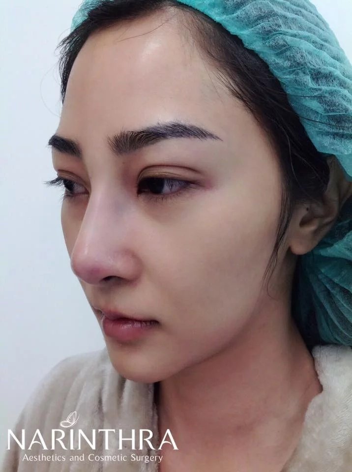 บทความ: รองปลายด้วยกระดูกอ่อนหลังหูจำเป็นขนาดไหน ?  บทความ: รองปลายด้วยกระดูกอ่อนหลังหูจำเป็นขนาดไหน ?