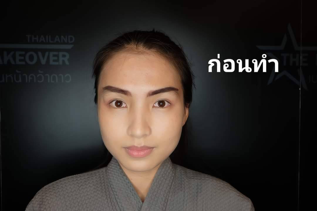 ลยกรรมหน้าผากข้อดีข้อเสีย