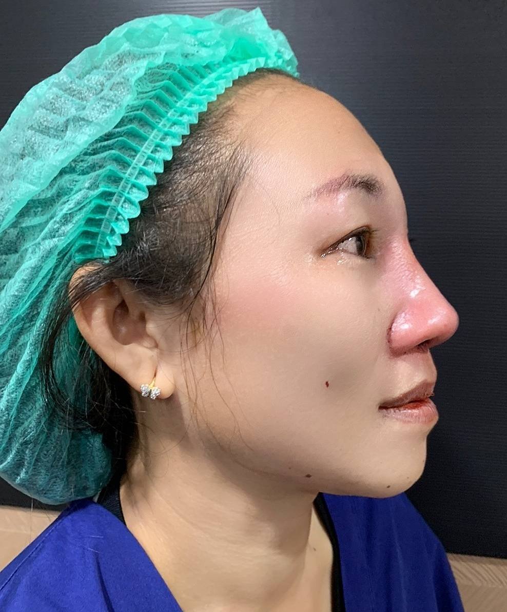 เทคนิคพิเศษตอกฐานจมูกไร้รอยแผลของ+SongnaeClinic