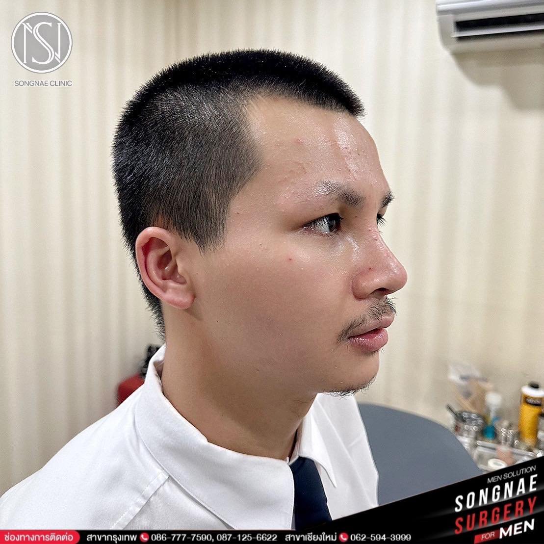 ทรงจมูกผู้ชาย