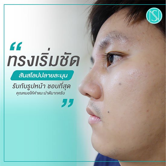 รีวิวแก้จมูก ผู้ชาย
