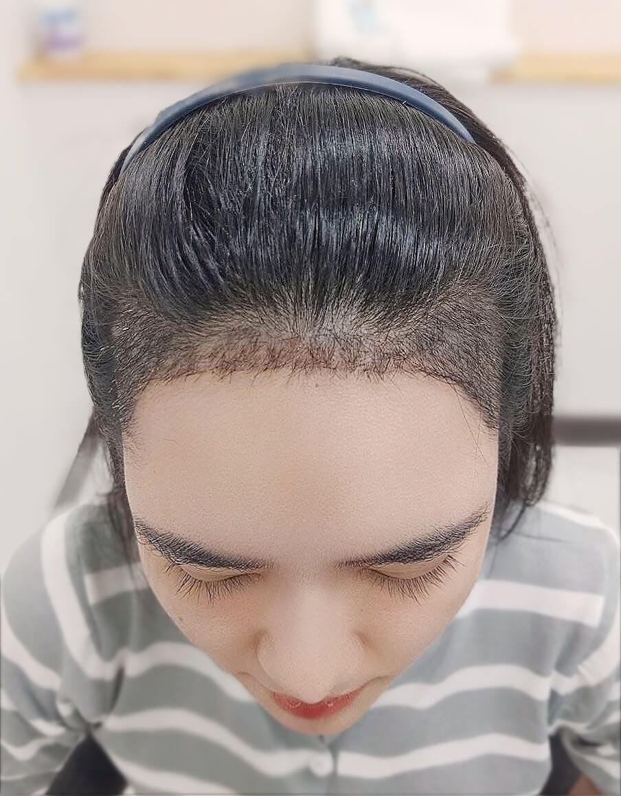 ปลูกผมถาวร  FUE