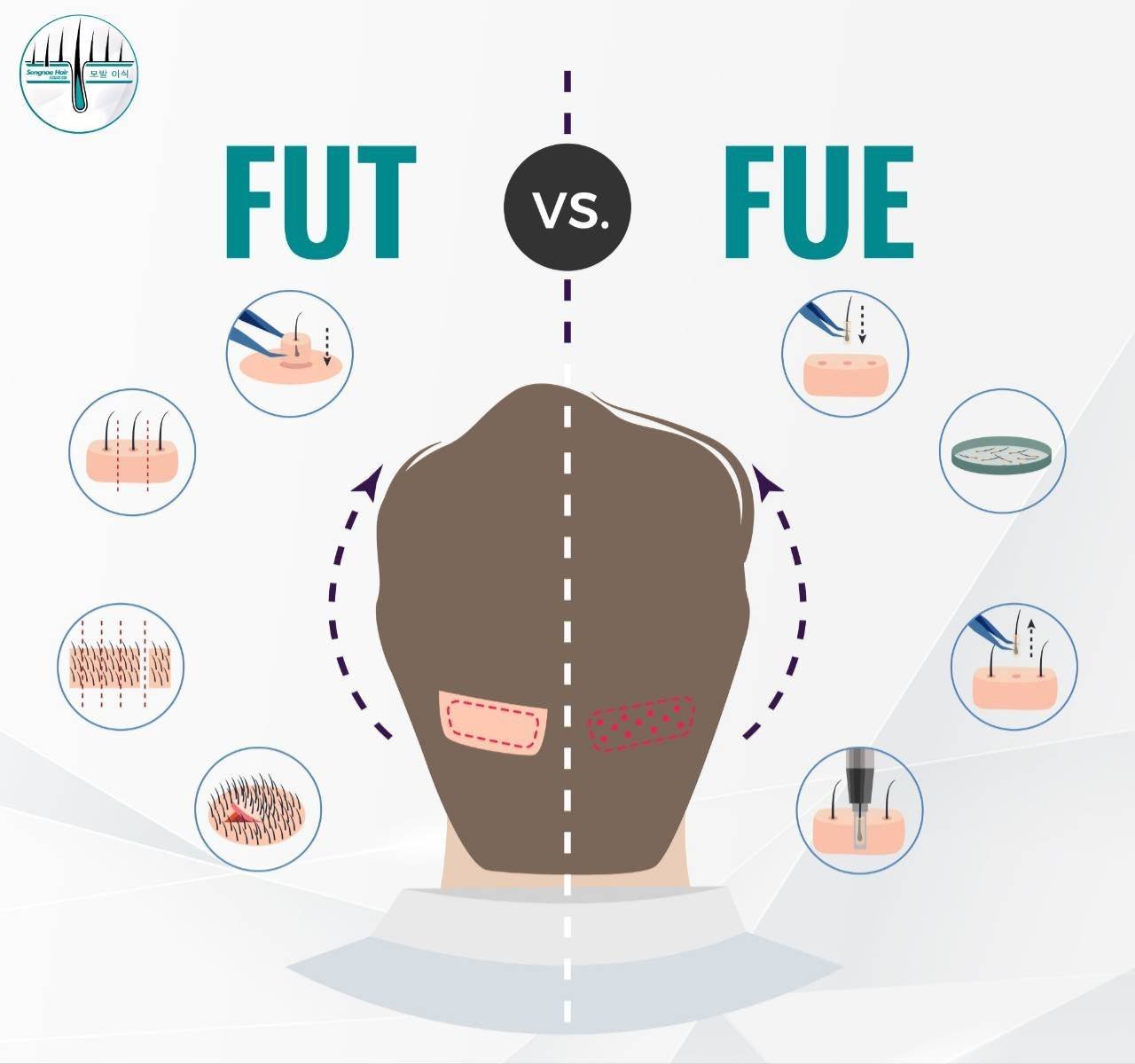 ปลูกผม_เทคนิค_fue_fut_ต่างกันอย่างไร