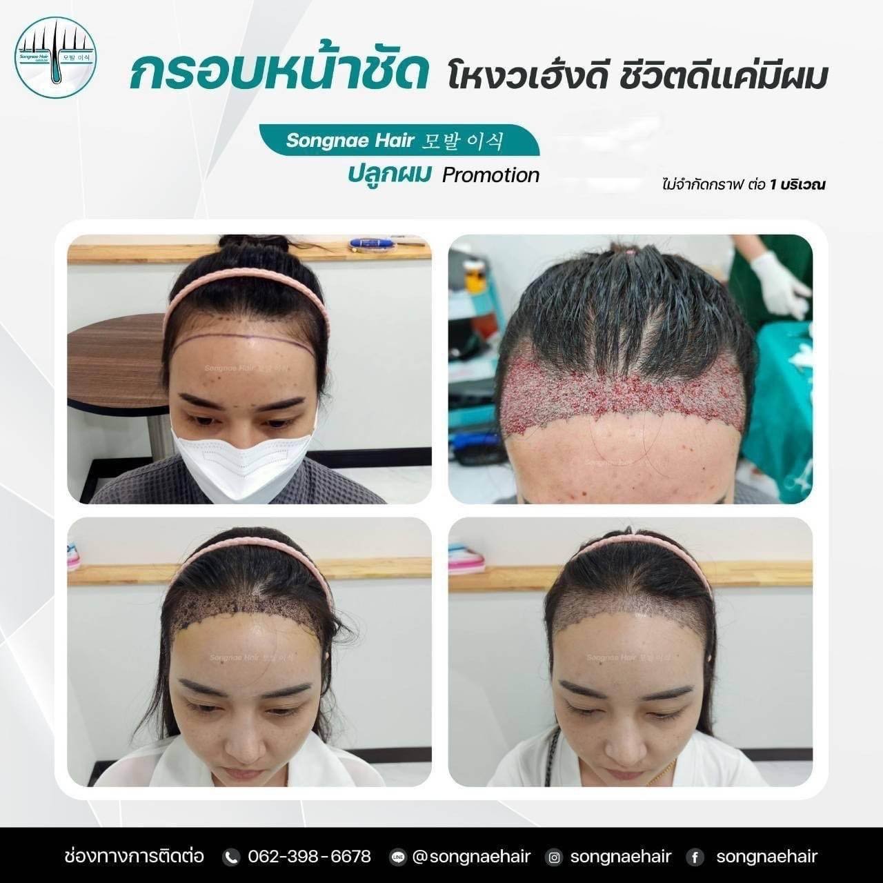 โปรโมชั่นปลูกผม FUE