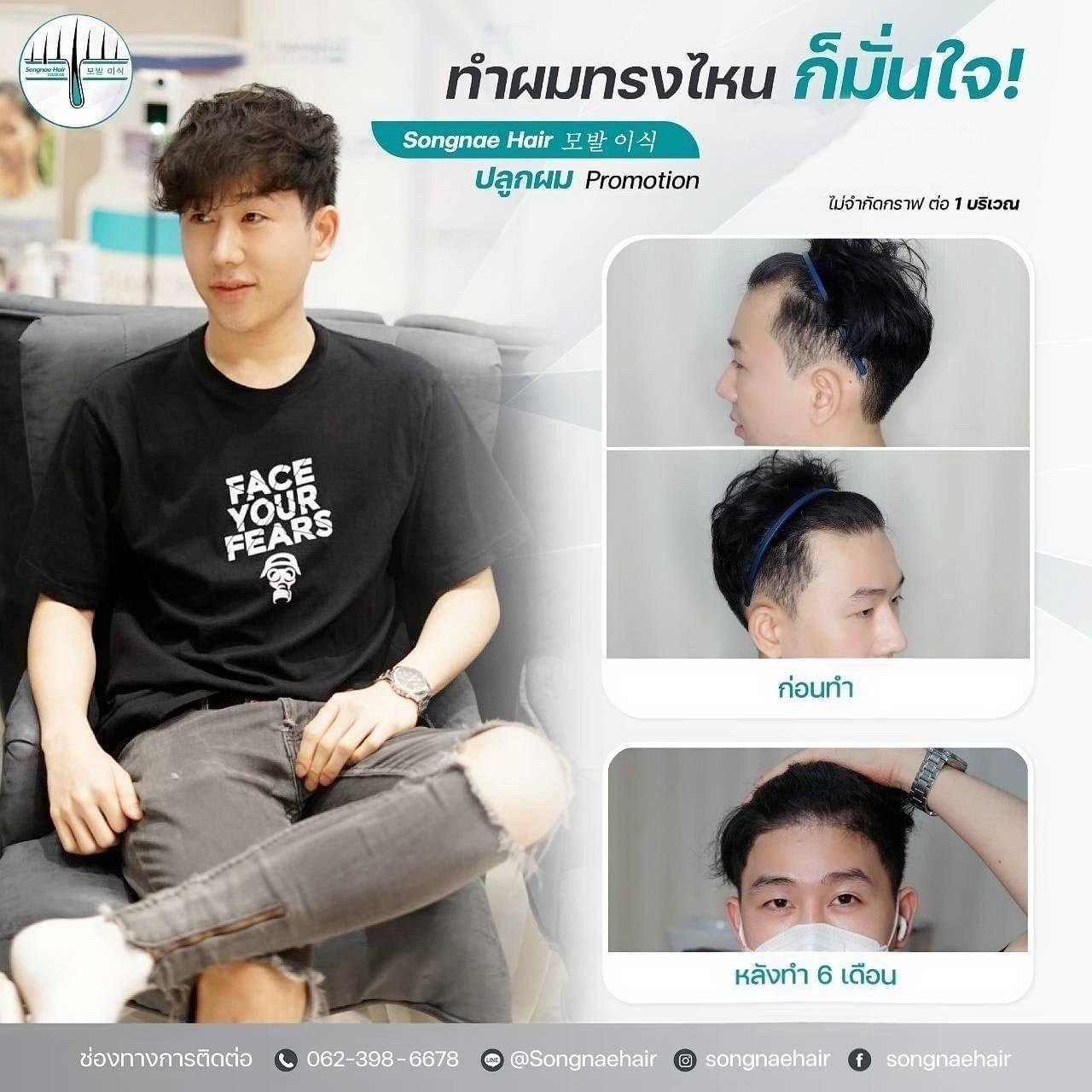 โปรโมชั่นปลูกผม_FUE_ราคาพิเศษที่ไหนดี