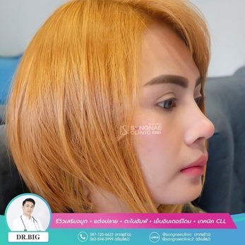 ศัลยกรรมจมูก