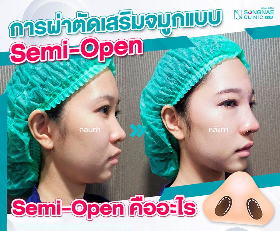 เซมิโอเพ่นคือ