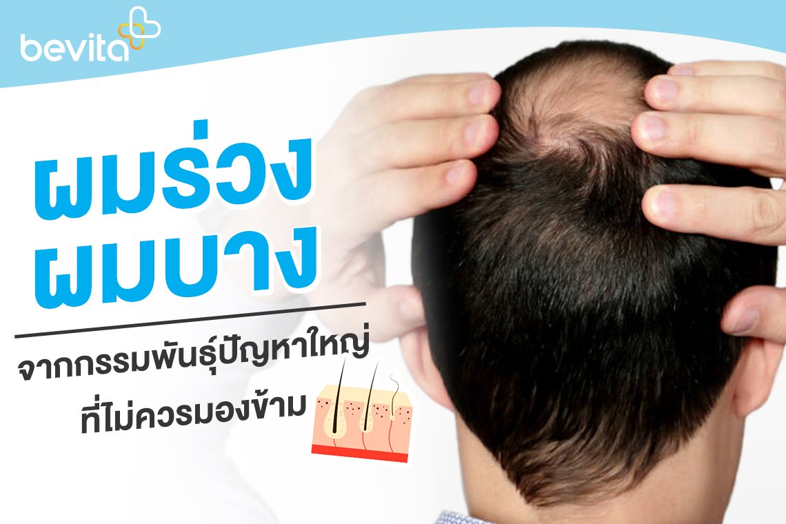 ผมร่วง ผมบางมาก จนหัวล้านปัญหาใหญ่ที่ไม่ควรมองข้าม ผมร่วง ผมบางมาก จนหัวล้านปัญหาใหญ่ที่ไม่ควรมองข้าม