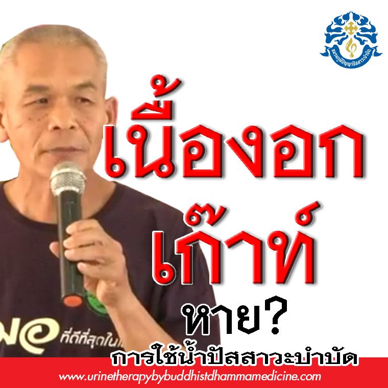 เนื้องอก เก๊าท์ หายด้วยสิ่งนี้