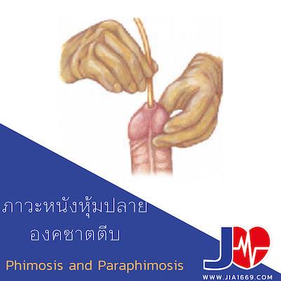 Phimosis and Paraphimosis ภาวะหนังหุ้มปลายองคชาตตีบ