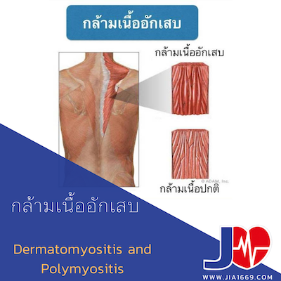 Dermatomyositis and POLYMYOSITIS โรคกล้ามเนื้ออักเสบ