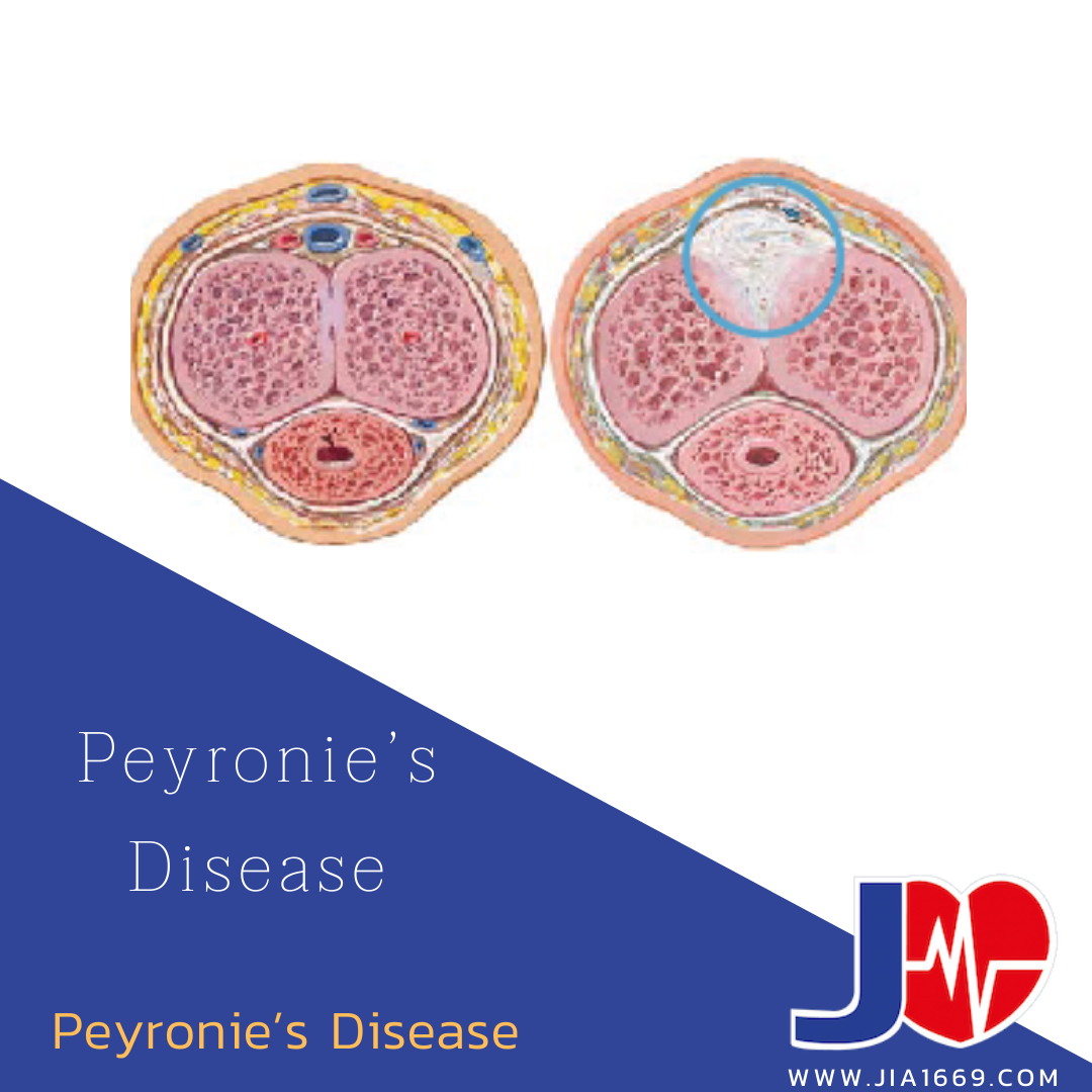 Peyronie’s Disease - jia1669
