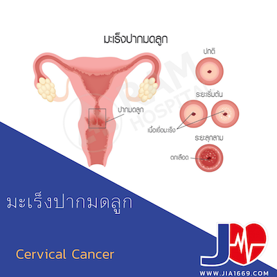 cervical cancer
