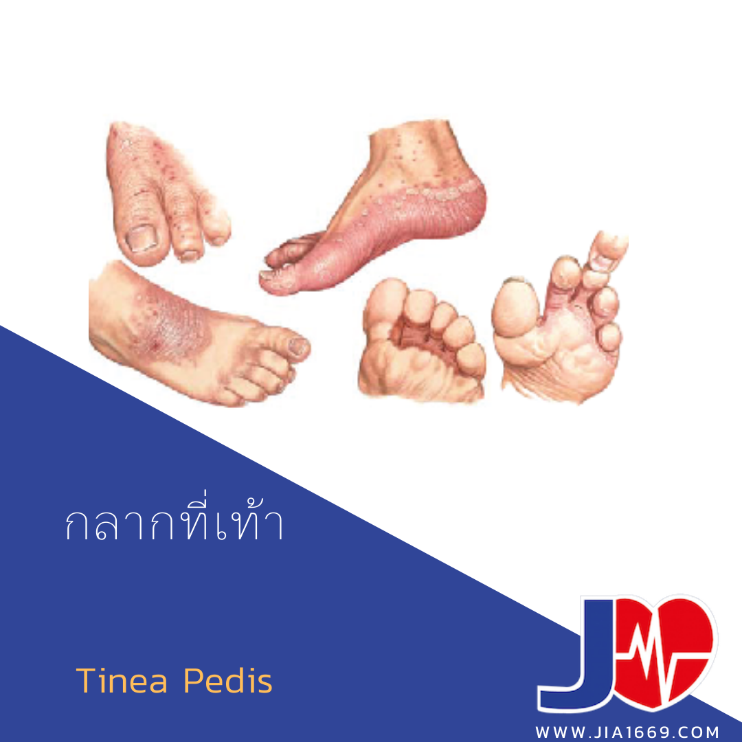 โรคกลากที่เท้า Tinea Pedis