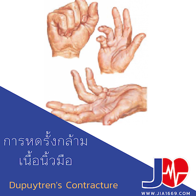 Dupuytren’s Contracture การหดรั้งกล้ามเนื้อนิ้วมือ