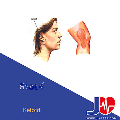 keloids