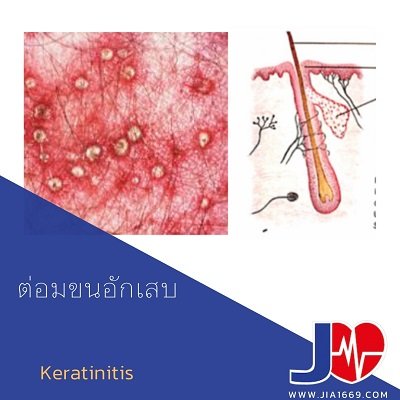 keratinitis
