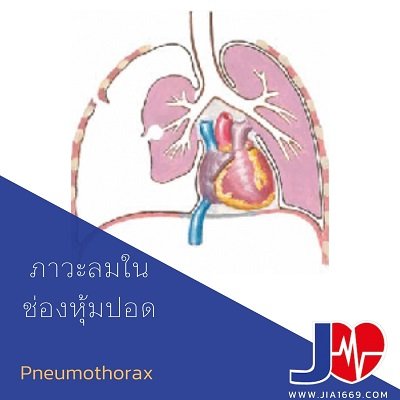 ภาวะลมในช่องหุ้มปอด Pneumothorax