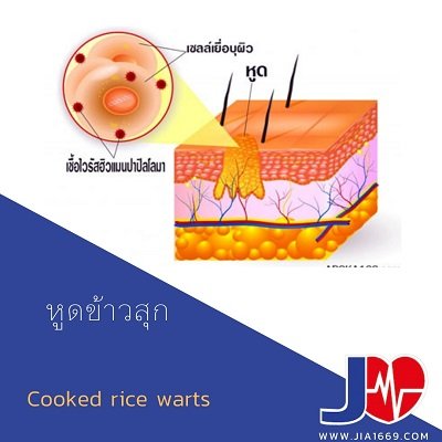 Cooked rice warts