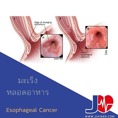 มะเร็งหลอดอาหาร(esophageal cancer)