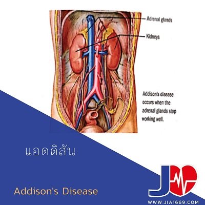 ADDISON’S DISEASE