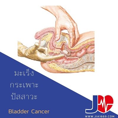 มะเร็งกระเพาะปัสสาวะ Bladder Cancer 