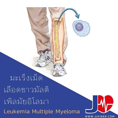 Leukemia multiple myeloma