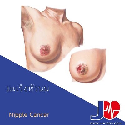 มะเร็งหัวนม PAGET’S DISEASE OF THE BREAST