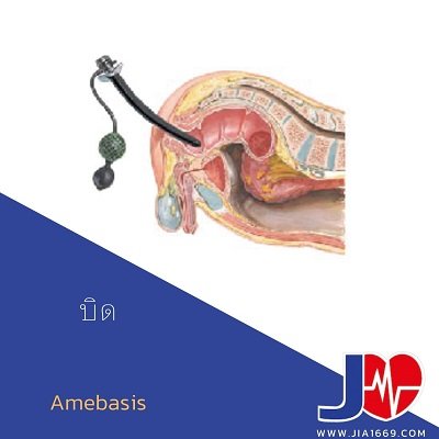 โรคบิด amebasis