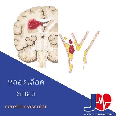 cerebrovascular disease