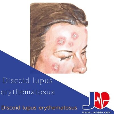 Discoid lupus erythematosus โรคดีแอลอี