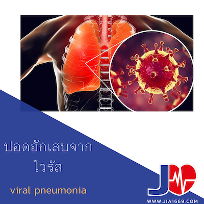 ปอดอักเสบจากไวรัส(Pneumonia)