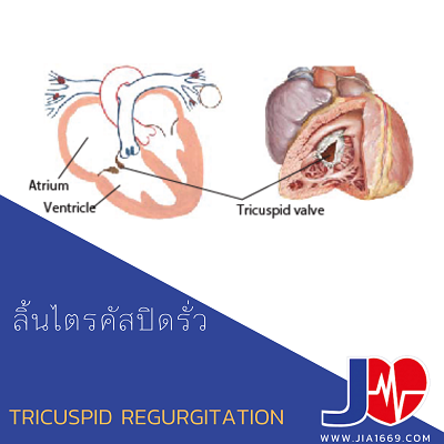 TRICUSPID REGURGITATION
