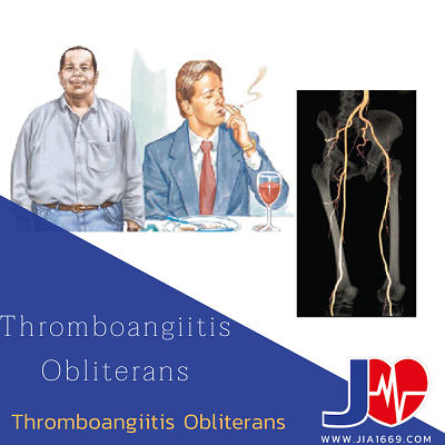 Thromboangiitis Obliterans