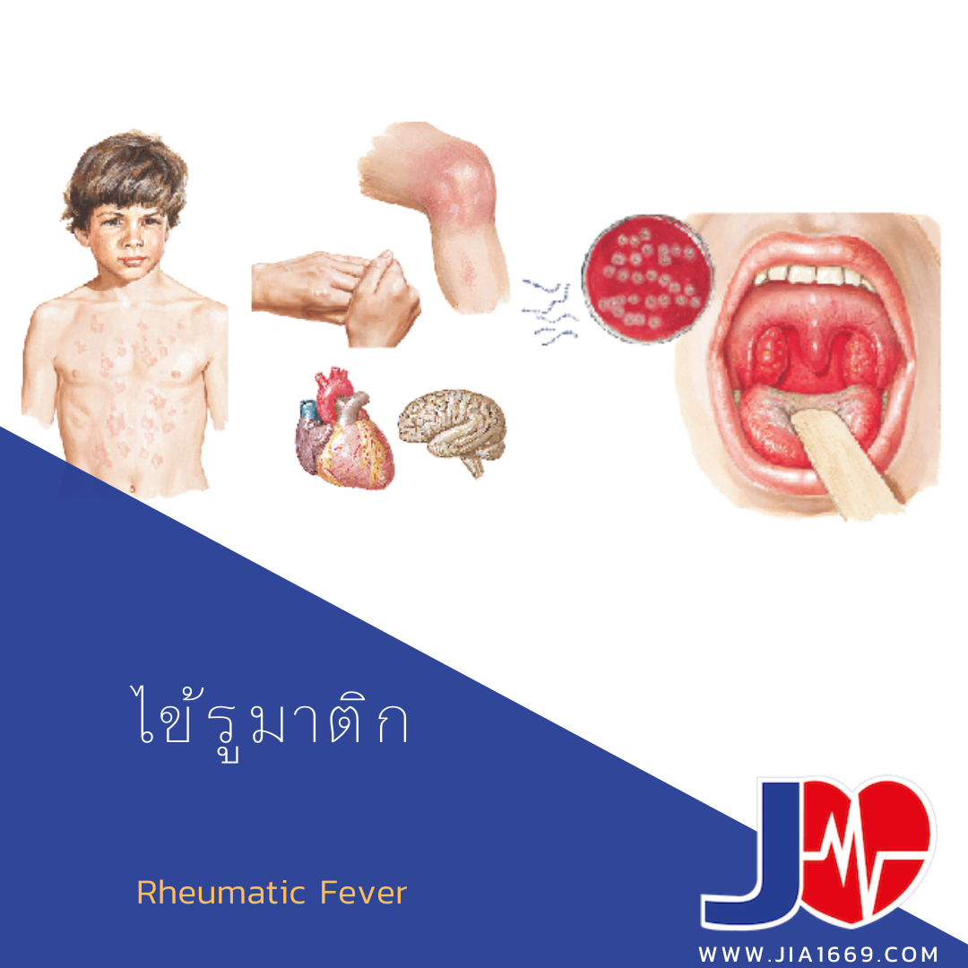 Rheumatic Fever 