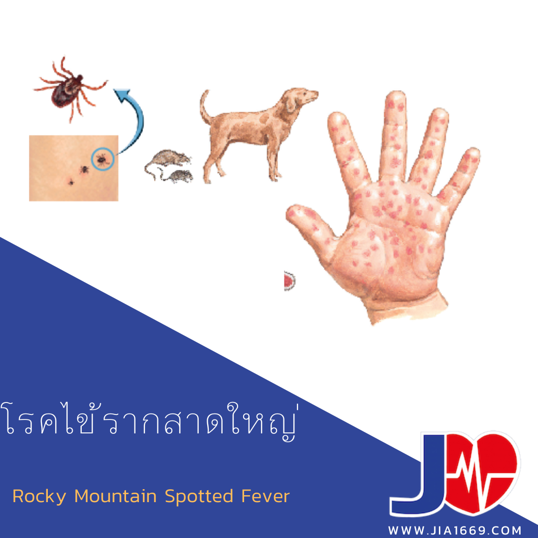 Rocky Mountain Spotted Fever 